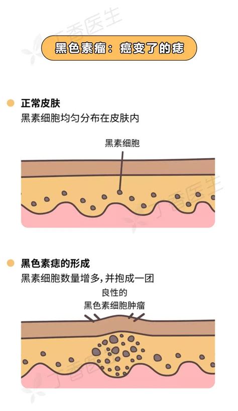 痣上面長痘痘|痣也可能会癌变！长在 3 个地方要注意